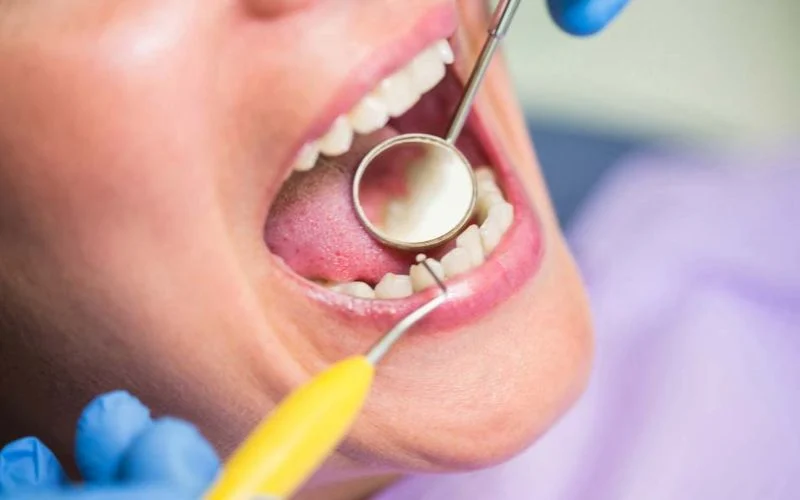 What is the Best Treatment for Tooth Decay?